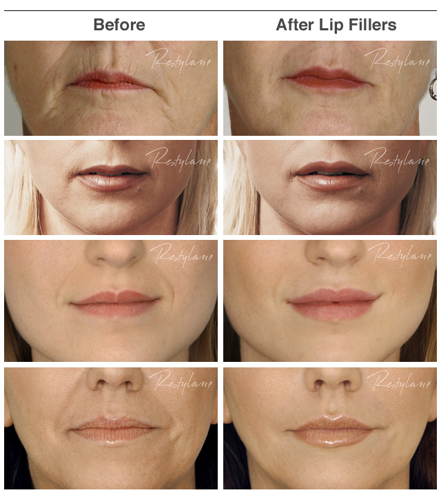 Lip Line Filler Before And After
