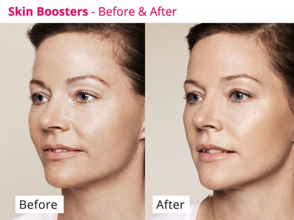 Restylane Skin Boosters Face Clinic London 