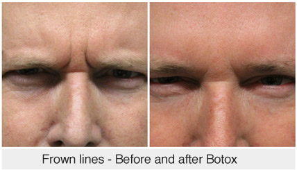 Frown lines - Before and after Botox