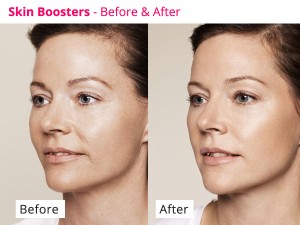 skinboosters-feature