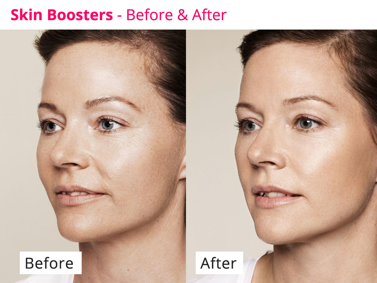 Restylane Skinboosters Vital