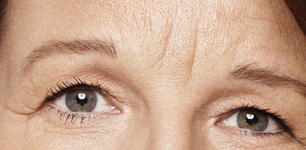 Wrinkle Treatment