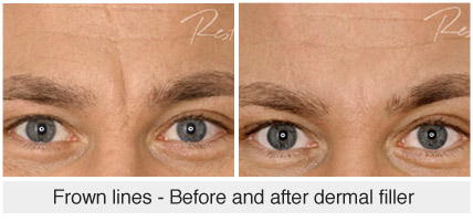Frown lines - Before and after dermal filler