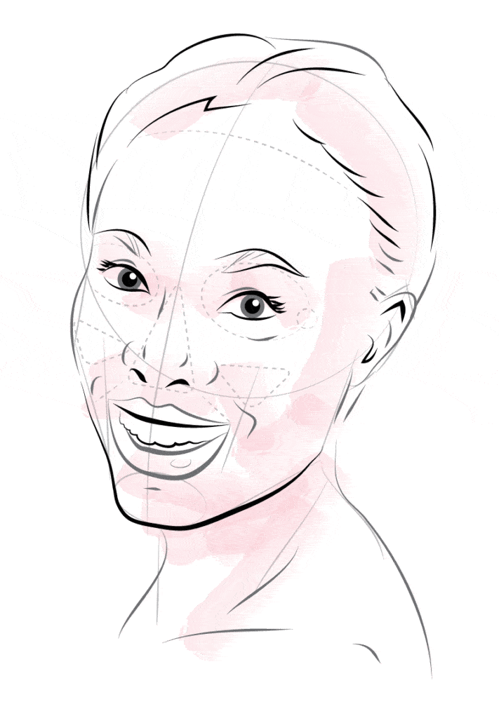 Illustration of model using Profhilo Bioremodelling, Restylane Skin Boosters and PRP