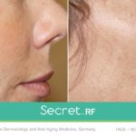 Before/After Secret RF London Treatment - fine line treatment, scars, stretch marks, wrinkles in London
