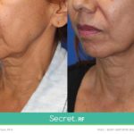 Before/After Secret RF London Treatment - Neck - fine lines, scars, stretch marks, wrinkles in London