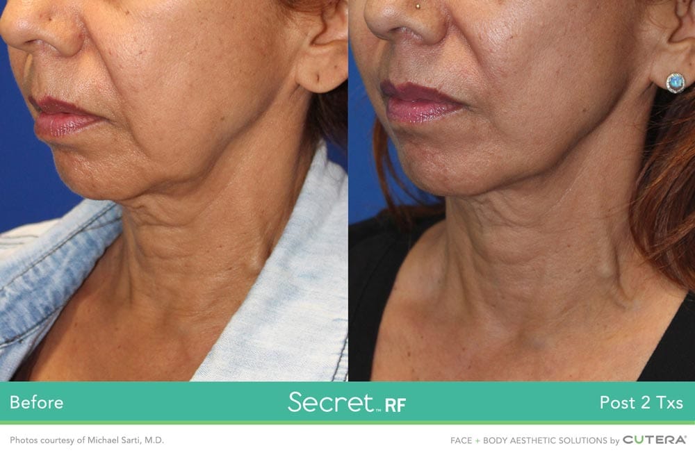 Before/After Secret RF London Treatment - Neck - fine lines, scars, stretch marks, wrinkles in London