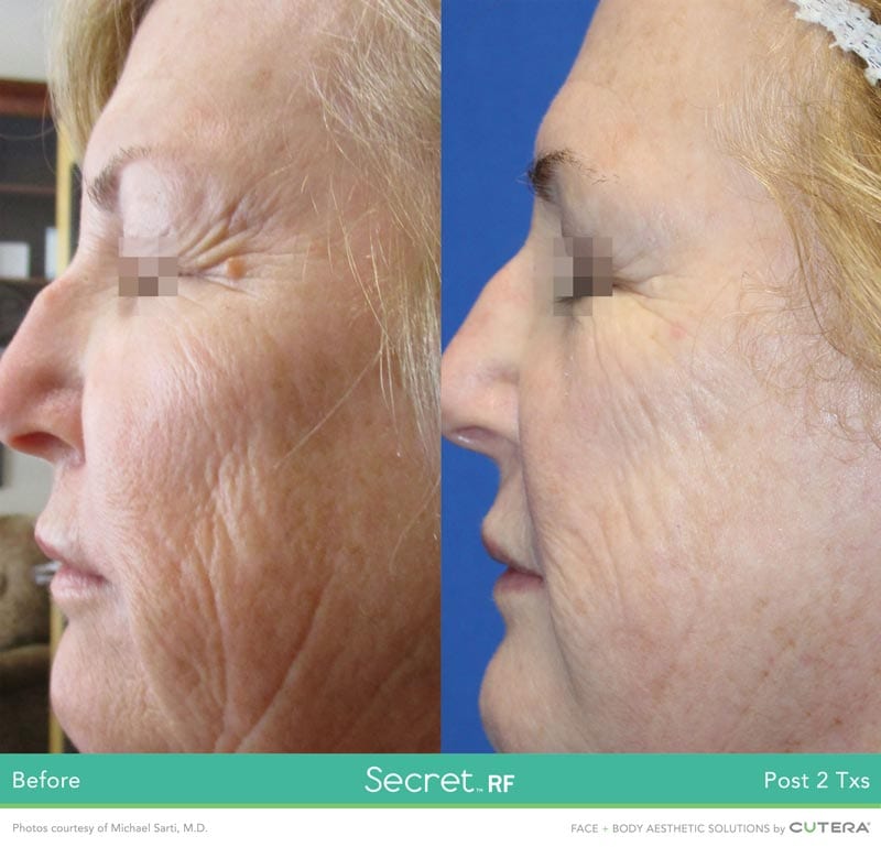 Before/After Secret RF London Treatment - fine lines, scar treatment, stretch marks, wrinkles in London