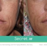 Before/After Secret RF London Treatment - fine lines, scars, stretch marks, wrinkles in London