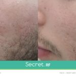 Before/After Secret RF London Treatment - acne scars, pot marks, fine lines, scars, stretch marks, wrinkles in London