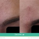 Before/After Secret RF London Treatment - Scarring treatment, fine lines, stretch marks, wrinkles in London