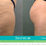 Before/After Secret RF London Treatment - fine lines, scars, stretch marks, wrinkles treatments in London