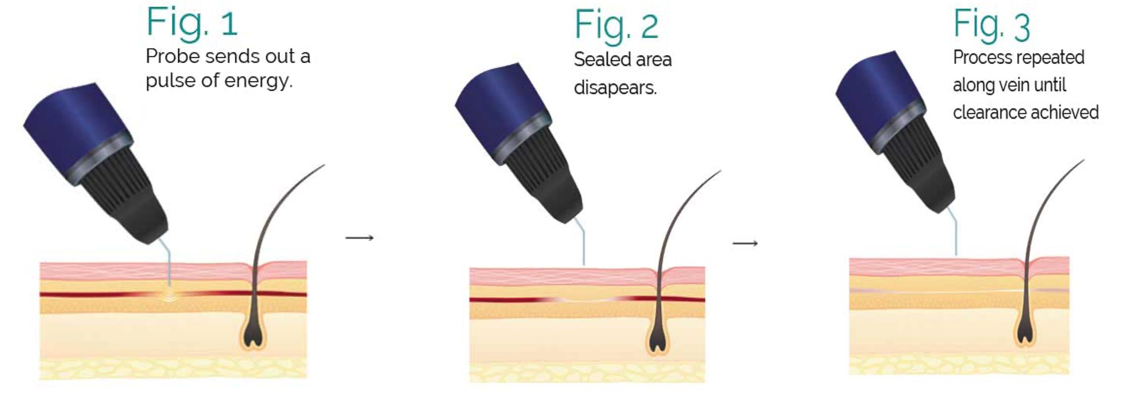 ThermaVein thermo-coagulation. Thermocoagulation works by gently joining the two walls of the vein together.