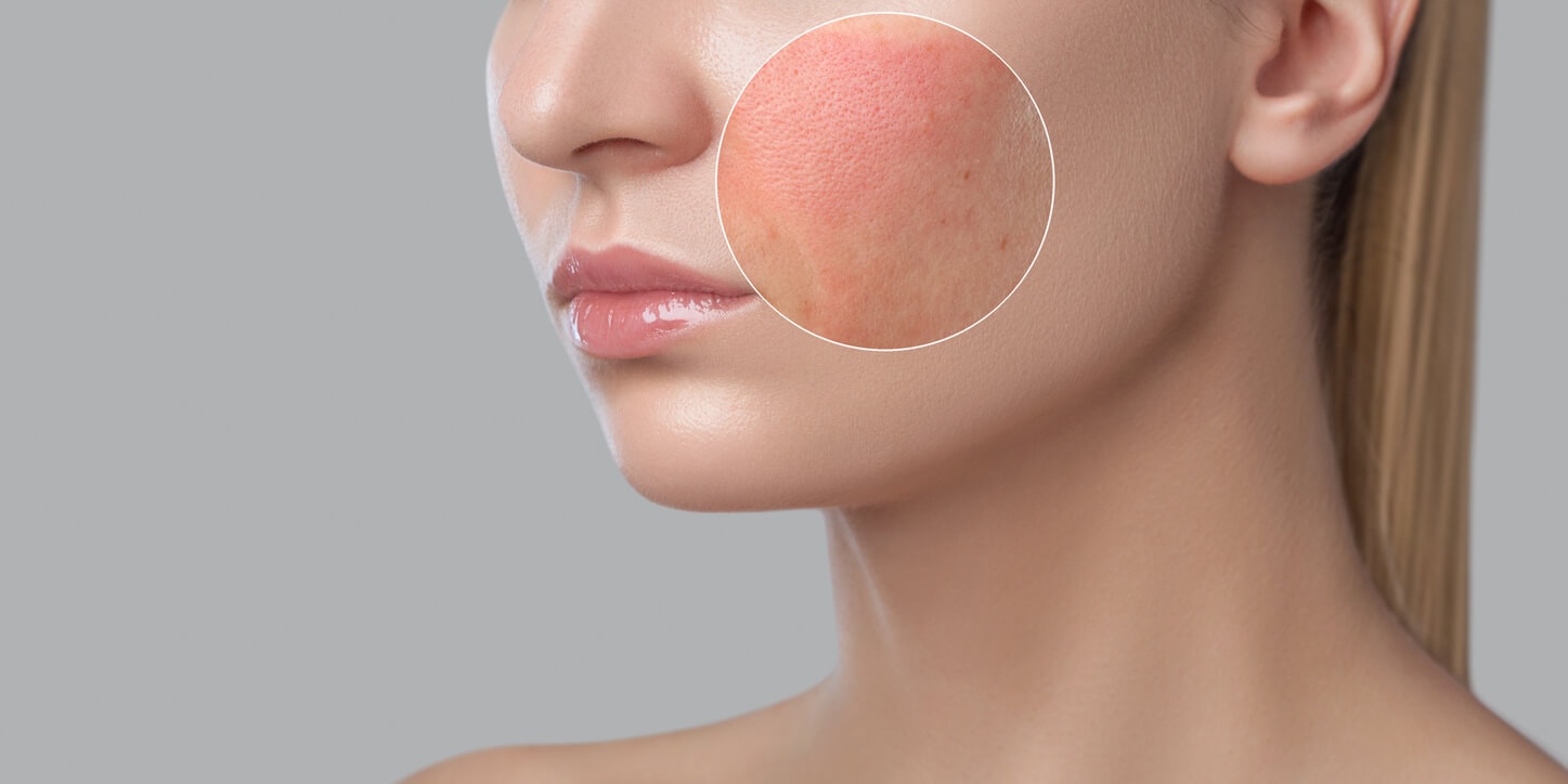 Oleanolic acid can reduces skin inflammation Oleanolic acid can reduces skin inflammation
