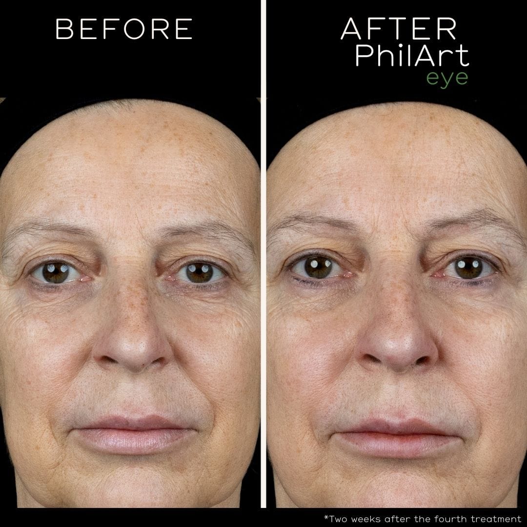 PhilArt Polynucleotides Face Clinic London