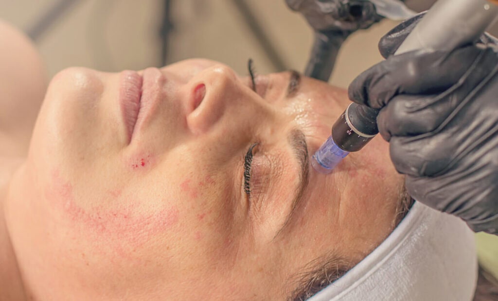 A female receiving Secret RF treatment in Soho, London