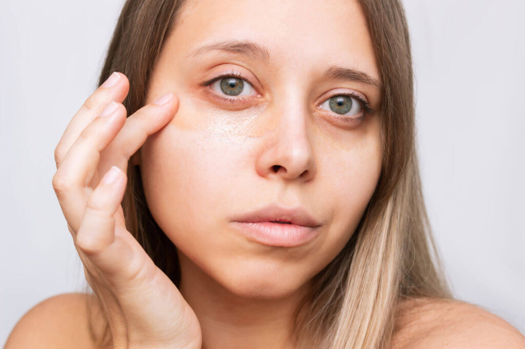 Woman covering dark circles around eyes with make up instead of Polynucleotides Treatment 