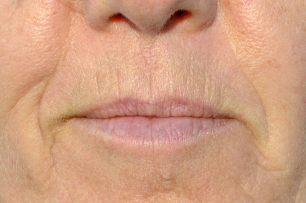 Lip wrinkles, also know as smokers' lines can be treated at Face Clinic London